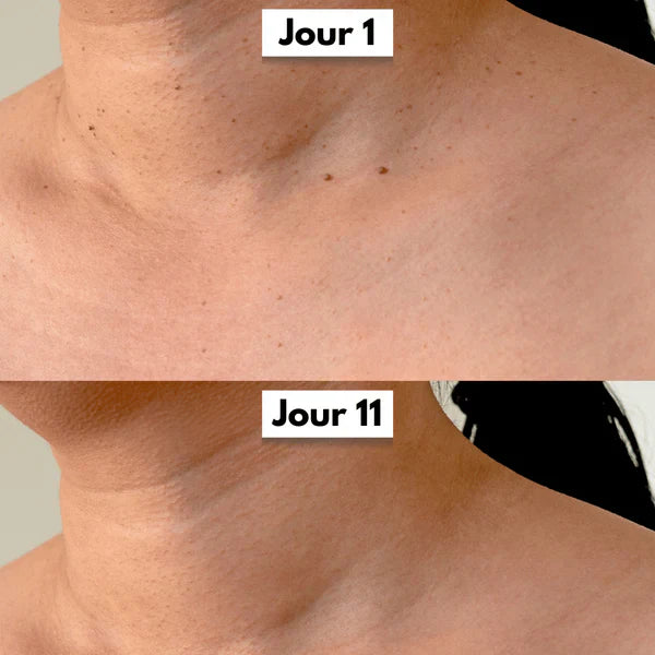 Kit DermaSkin Pro™ – Adieu Les Acrochordons, Résultat Immédiat