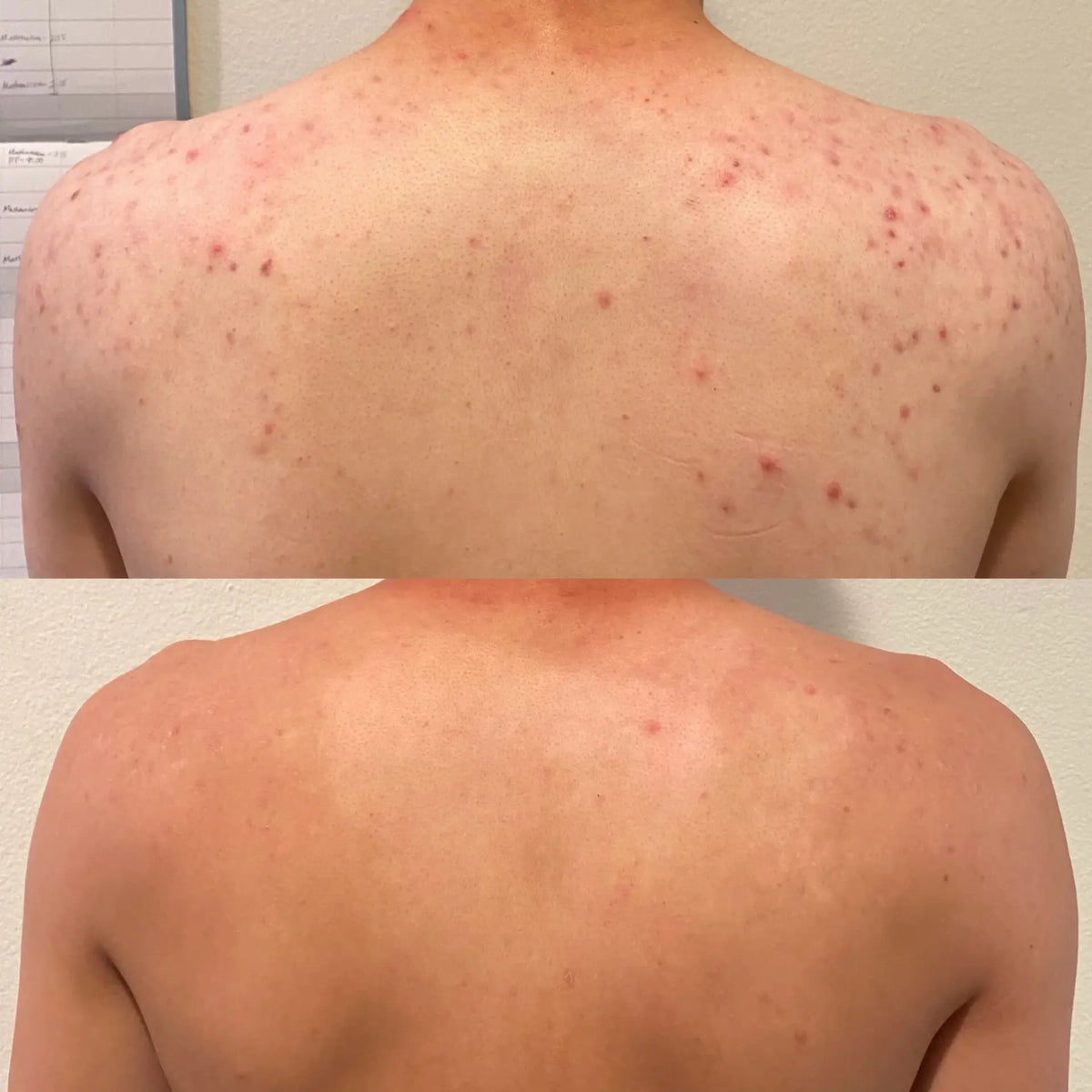 PanOxyl Nettoyant moussant contre l'acné, Peroxyde de benzoyle 10 %