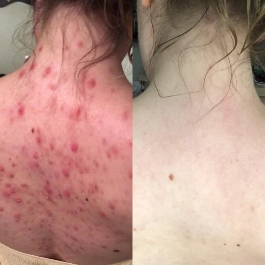 PanOxyl Nettoyant moussant contre l'acné, Peroxyde de benzoyle 10 %