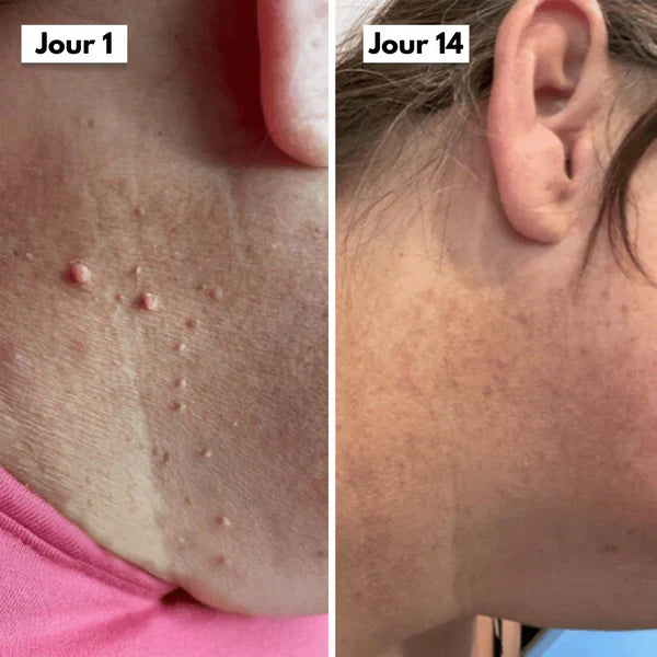 Kit DermaSkin Pro™ – Adieu Les Acrochordons, Résultat Immédiat